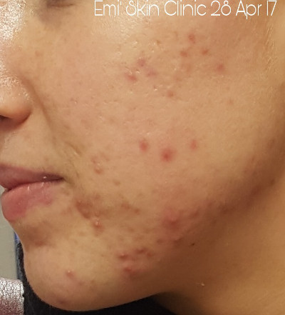 Jane Hanna accumax acne treatment
