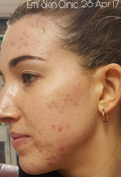 Jane Hanna uses accumax for acne